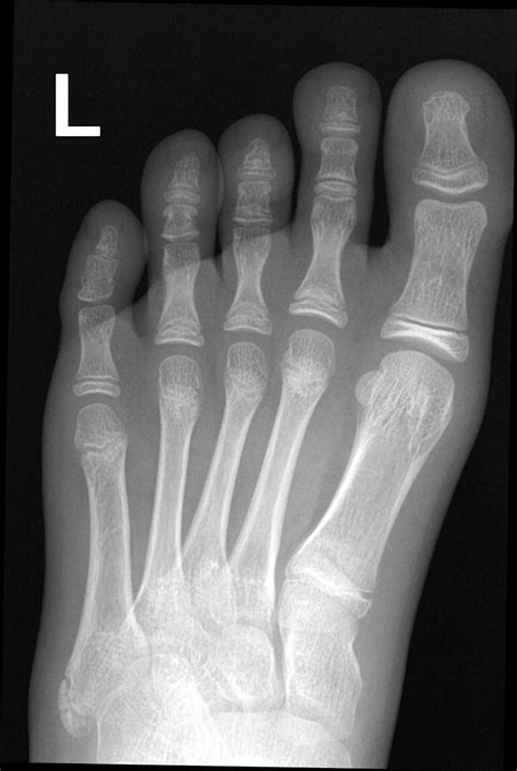 Apophysis Of The Fifth Metatarsal Radiology Case