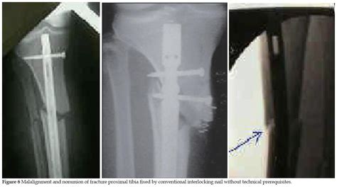 Fractures Of The Proximal Third Tibia Treated With Intramedullary