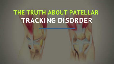 5 Exercises To Fix Patellar Tracking Disorder Precision Movement
