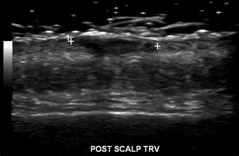 Ultrasound Images Of A Scalp Basal Cell Carcinoma Download Scientific