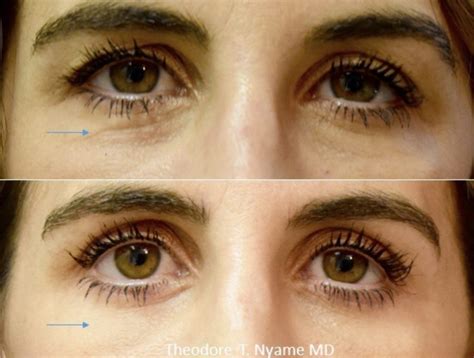 Remove Bags Under The Eyes Facial Rejuvenation Options