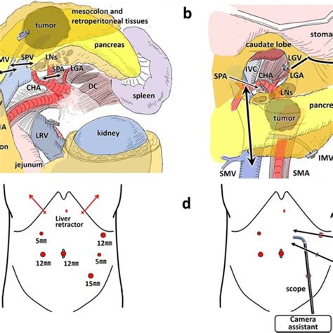 Schematic Illustrations Of The Left Posterior Approach And Trocar