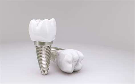 Common Questions About Dental Implants Answered Ashton Avenue Dental