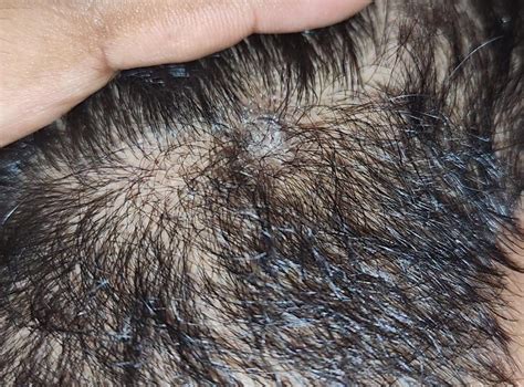 Bump On My Scalp Any Ideas Rdermatologyquestions