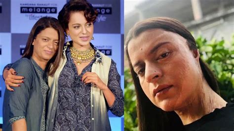 After Chhapaak Kangana Ranaut Sister Rangoli Chandel Shares Her Acid