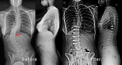 Non Fusion Corrective Scoliosis Surgery Scoliosis And Spine
