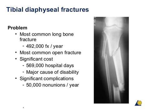 Diaphyseal Tibia And Femur Fractures