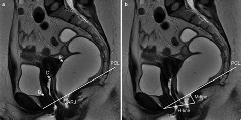 Mri Of The Pelvic Floor And Mr Defecography Diseases Of The Abdomen