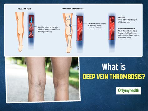 What Is Deep Vein Thrombosis Dvt Here Are Its Symptoms Causes
