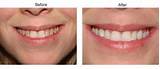 Teeth Bonding Insurance
