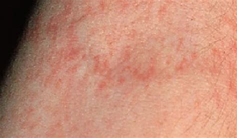 Scarlet Fever Rash Pictures Photos