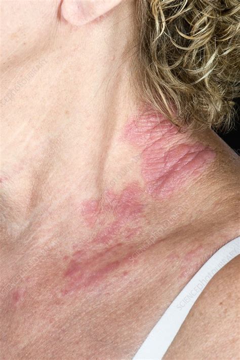 Eczema On The Neck Stock Image C0460999 Science Photo Library