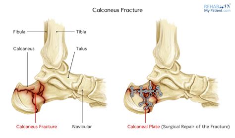 Calcaneus Fracture Rehab My Patient