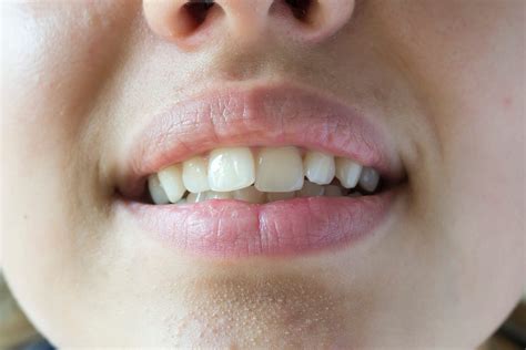 Lets Talk About Crooked Teeth Dr Elston Wong Dentistry