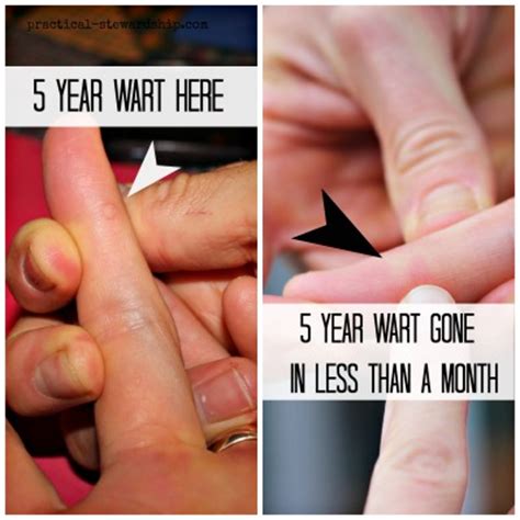 Same day delivery · recommended by doctors · featured in webmd How to Get Rid of Warts Naturally with One Ingredient ...