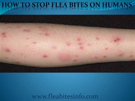 Infected Flea Bites On Humans