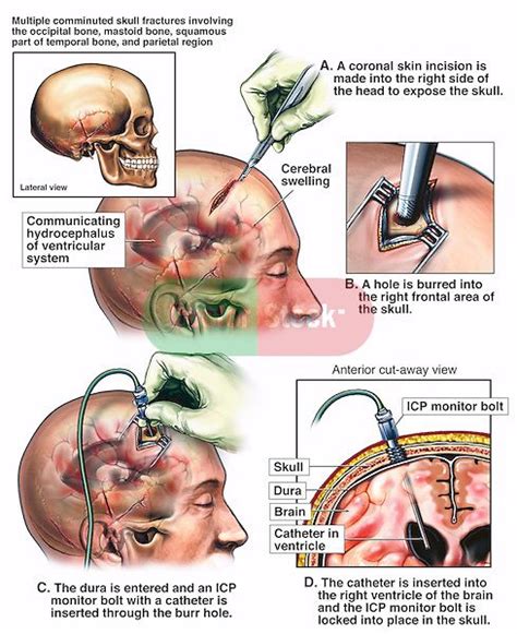 Brain Surgery Ventriculostomy And Placement Of Intracranial Pressure