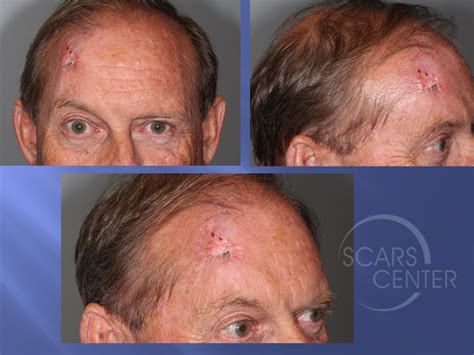 Stage 4 Basal Cell Carcinoma