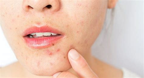 Five Effective Home Remedies For Acne Get Rid From Pimples Fast