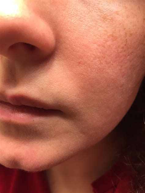 [skin Concerns] My Skin Has Tiny White Bumps Everywhere And Feels Like Sandpaper And I Have A G