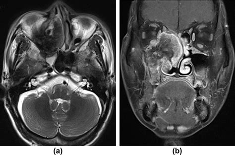 Ct And Mri Of Radiation Induced Sarcomas Of The Head And Neck Following