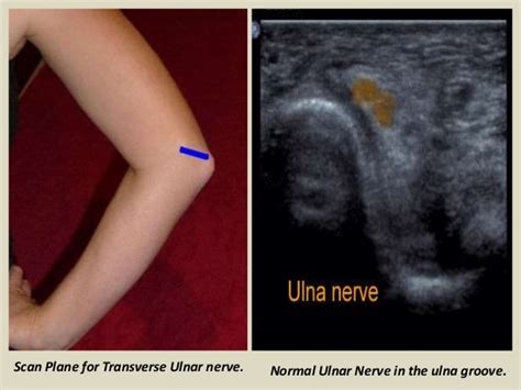 Ulnar Nerve Elbow Ultrasound