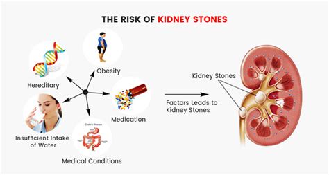 Kidney Stones Ouch Causes Symptoms Treatment Knoxville Hospital