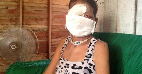 G1 Mulher Que Perdeu Olho Nariz E Boca Por Causa Do Câncer Pede Ajuda Notícias Em Amapá