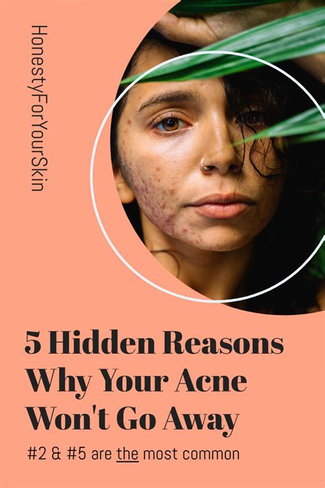 Acne Won T Go Away Help These Are The Hidden Reasons Why Acne Reasons Everyday Skin Care