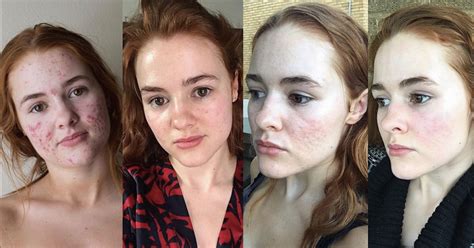 My Face Story Acne Journey Instagram Accutane Essay