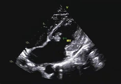 Infective Endocarditis With Recurrent Epistaxis In A Young Patient A