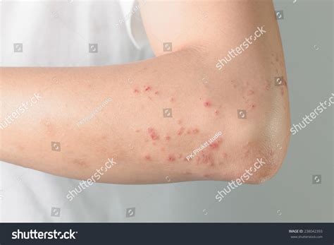 Atopic Dermatitis Allergic Chemicalsitchy Skin Lesions Stock Photo