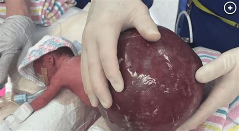 Australian Hospital Saves ‘miracle Baby Born With Tumor Double Her