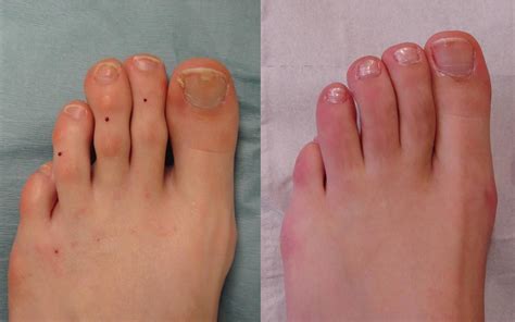 What Is Toe Shortening Surgery