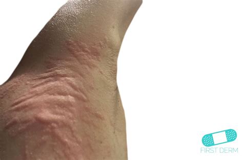 Online Dermatology Hives Urticaria