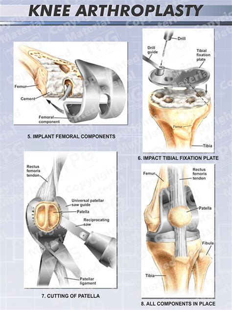 Knee Arthroplasty 2 Of 2 Right