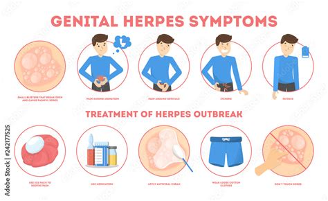 Genital Herpes Symptoms Infectious Dermatology Disease Illustration Stock Vector Adobe Stock