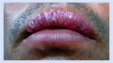 Pictures Of Purple Spots On Lips Sitelip Org