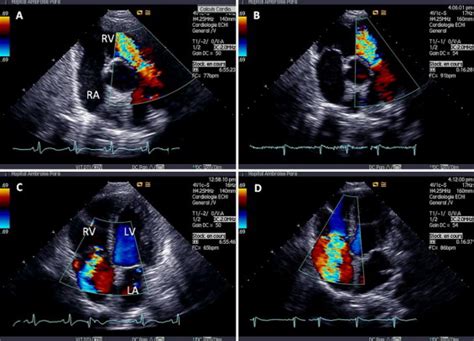 Echocardiographic Follow Up Of Treated Patients With Carcinoid Syndrome