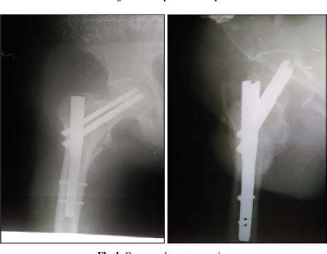 Figure 4 From Intertrochanteric Fracture Treated With Tfn Trochanteric