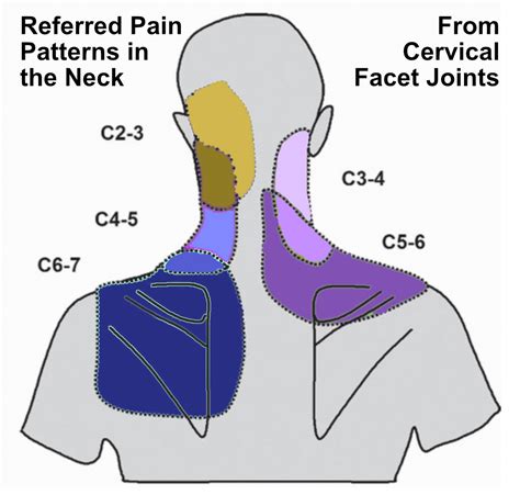 Referred Pain Back Care Clinic