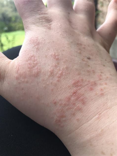 Ive Had This Rash On My Hands Off And On For About A Year Nothing
