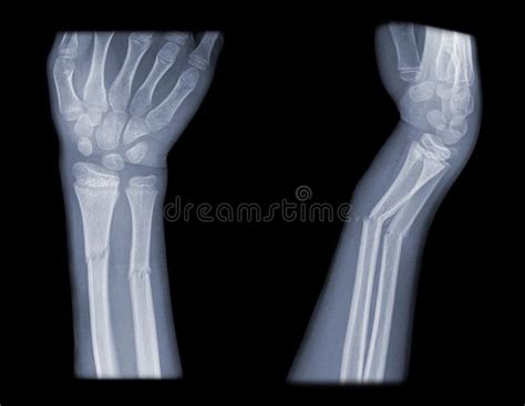 Distal Arm Fracture Stock Images Image 14031924