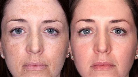 Cosmetic Conditions Laser And Skin