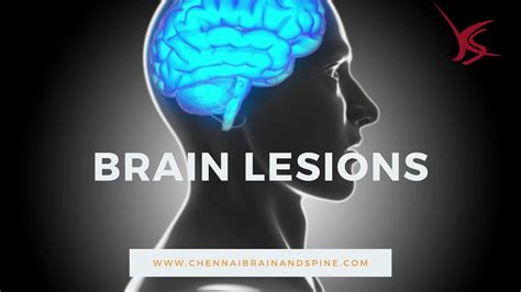 Brain Lesions Brain Lesions Treatment In Chennai Dr Shyam Sundar K
