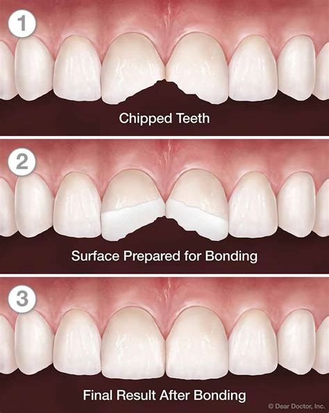 Composite Bonding Panoramic Dental Walnut Creek California