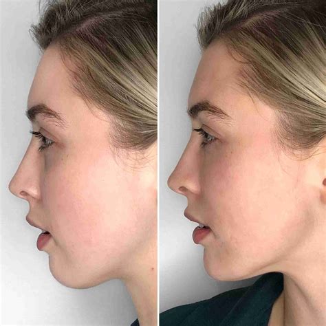 Chin Filler Example 1 Dr Aaron Stanes Anti Ageing And Cosmetic Medicine