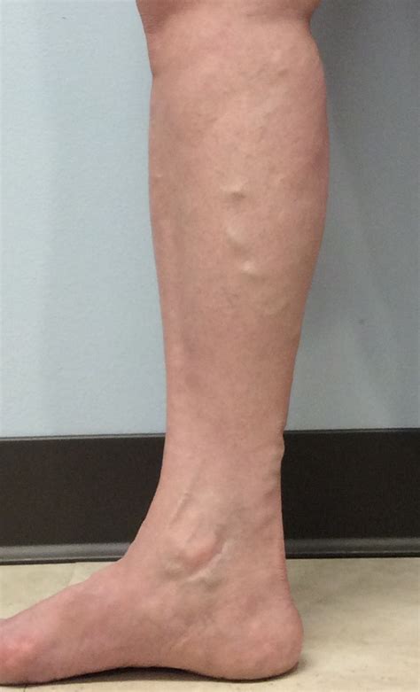Venous Insufficiency Pictures And Images A Visual Guide