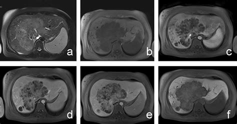 Imaging Features Of Intrahepatic Cholangiocarcinoma In Gd Eob Dtpa