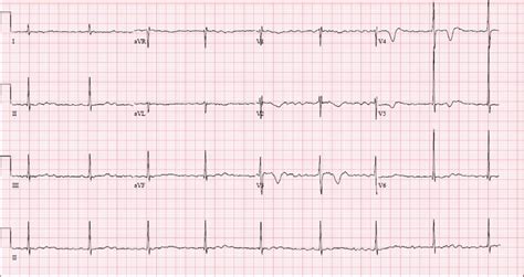 This week we review the answers to the last 6 questions + bonus from the 8th annual umem residency ecg competition. Third Degree 3rd Degree Heart Block Ecg - Photos Idea